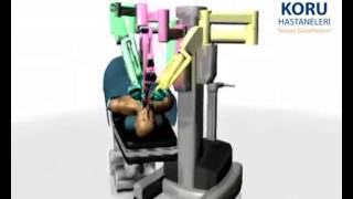 da Vinci Robotik Cerrahi Sistemi - Koru Hastanesi +90-312-287-9797
