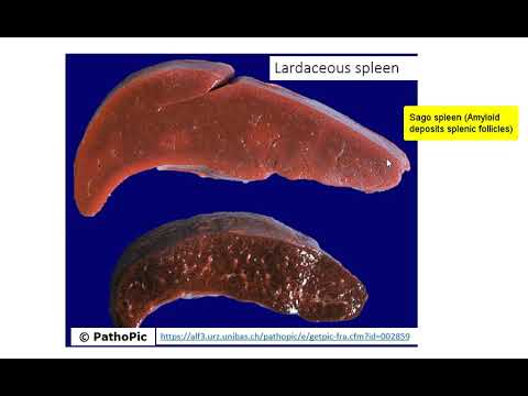 Liver Amyloidosis