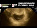 Kehamilan 10 Minggu Normal