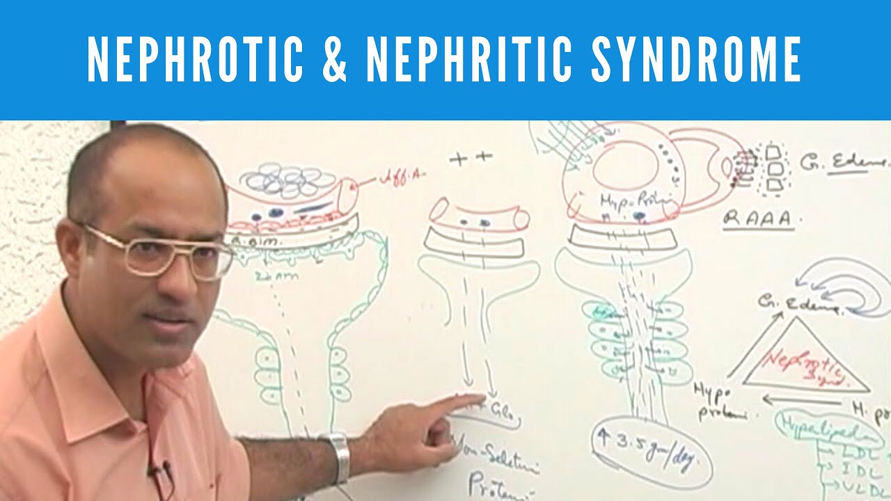 Nephrotic & Nephritic Syndrome | Causes , Symptoms & Treatment | Nephrology