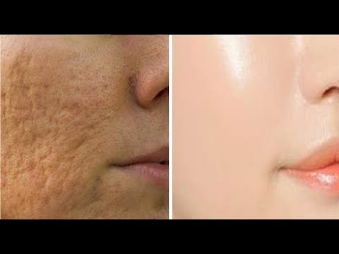 7 DAYS AND ALL OPEN PORES WILL DISAPPEAR FROM YOUR SKIN FOREVER | THE SECRET TO SHRINK LARGE PORES