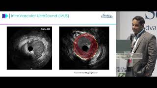 TCT 2024 Case Study | AGENT Drug-Coated Balloon Presented by Dr. Jubin Joseph, MD, PhD
