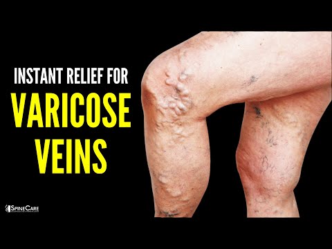 How to Instantly Relieve Varicose Vein Pain