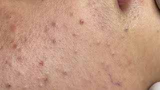 Soothing Facial Treatment for Acne-Prone Skin 647 P5