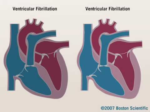 Sudden Cardiac Arrest