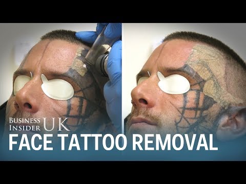 , title : 'Watch This Man Have His Face Tattoo Removed From Laser Surgery | Business Insider'
