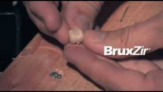 Solid Zirconia Crown vs PFM by Glidewell Laboratory