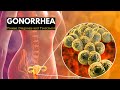 Gonorrhea, Causes, Signs and Symptoms, Diagnosis and Treatment.