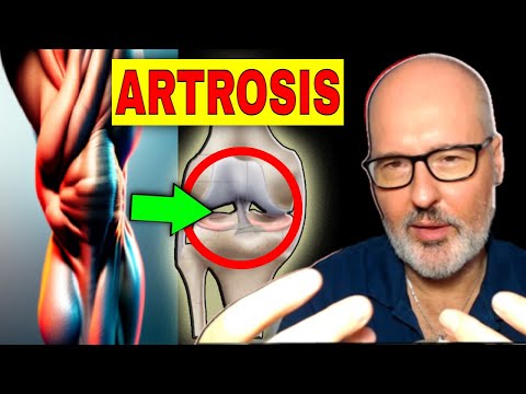 ARTHROSIS ???? SYMPTOMS, CAUSES AND TREATMENT