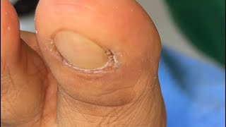 Ep_8654 Foot nails skin removal 👣 ทำไม.มันถึงออกยากคะ 🙂 (clip from Thailand)