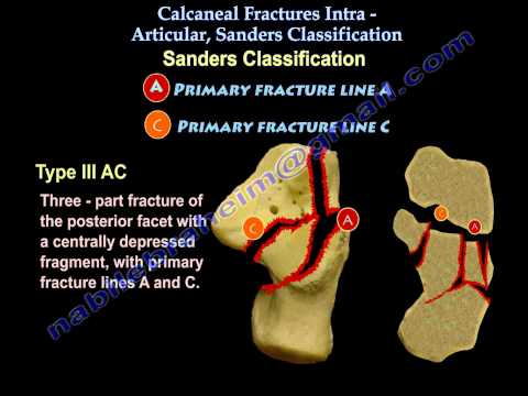 Calcaneal Intra-Articular Fractures, Sanders - Everything You Need To Know - Dr. Nabil Ebraheim
