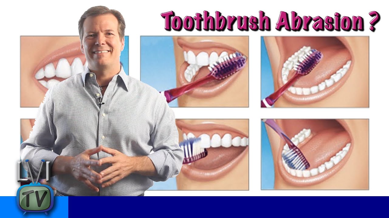 Toothbrush Abrasion? - LVI TV: Episode 23