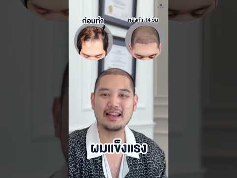 หลังปลูกผม เทคนิค FUE 14 วัน