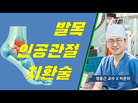 발목 인공관절 치환술(비온뒤 방송 출연)