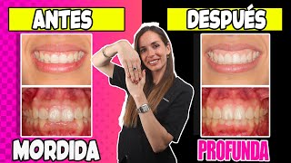 🟡¿Qué es la 𝐌𝐎𝐑𝐃𝐈𝐃𝐀 𝐏𝐑𝐎𝐅𝐔𝐍𝐃𝐀 en ORTODONCIA  Como 𝗖𝗢𝗥𝗥𝗘𝗚𝗜𝗥 ✅la SOBREMORDIDA Vertical