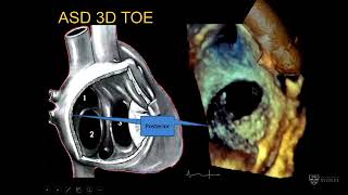 Interventional devices in adult congenital heart disease – Prof Greg Scalia