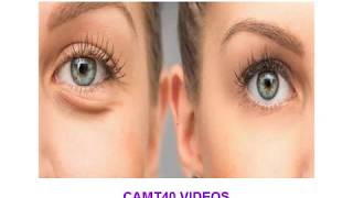 Eye Bag Removal - Best Eye Bag Removal