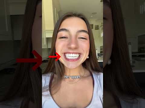 Perfect TEETH but still got braces!?
