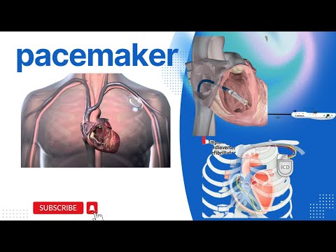 What is pacemaker how to work and Working Principle Advantage and Disadvantage