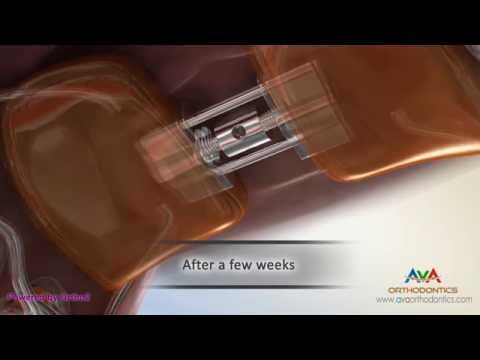 Orthodontic Expander or Spacer - Haas Appliance