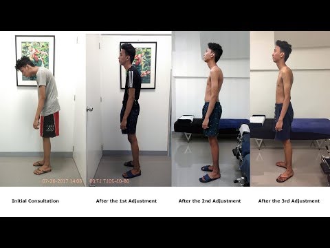 Gonstead Chiropractic helps 19-year old patient with extreme kyphosis
