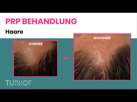 PRP Haare - Eigenbluttherapie bei Haarausfall | Dr. Turkof | 1060 Wien
