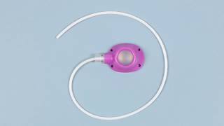 Insertion of a totally implantable vascular access device (TIVAD)