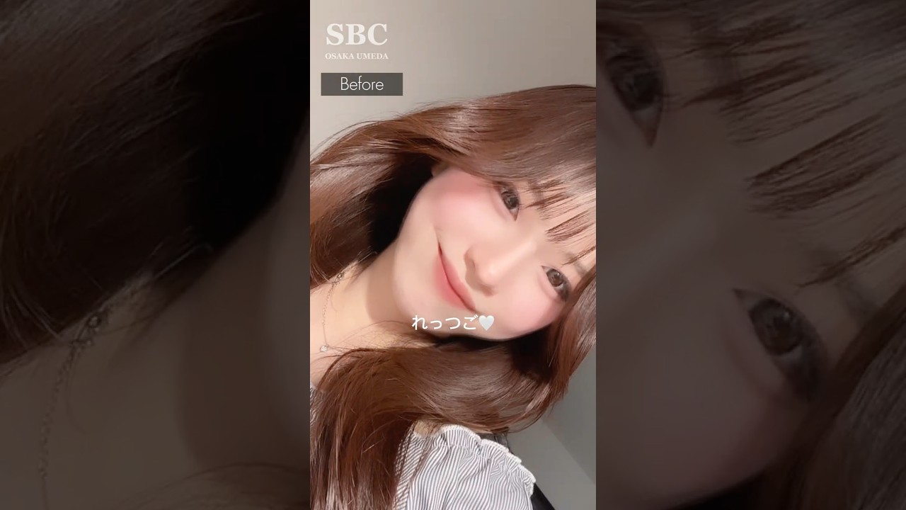 爆美女コンシェルジュが登場👸💖術後の夜〜術後1ヶ月のリアルダウンタイムを大公開🫣🌈 #埋没 #クイックコスメティーク #二重埋没法 #二重 #二重整形