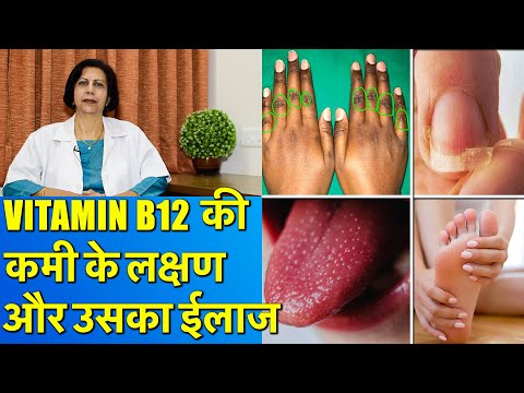 Vitamin B12 Deficiency Symptoms and Treatment