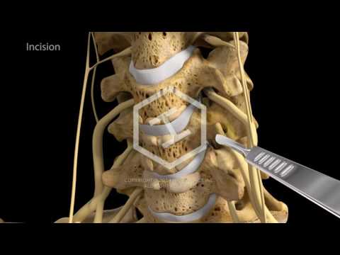 Cum se tratează artroza costală transversală