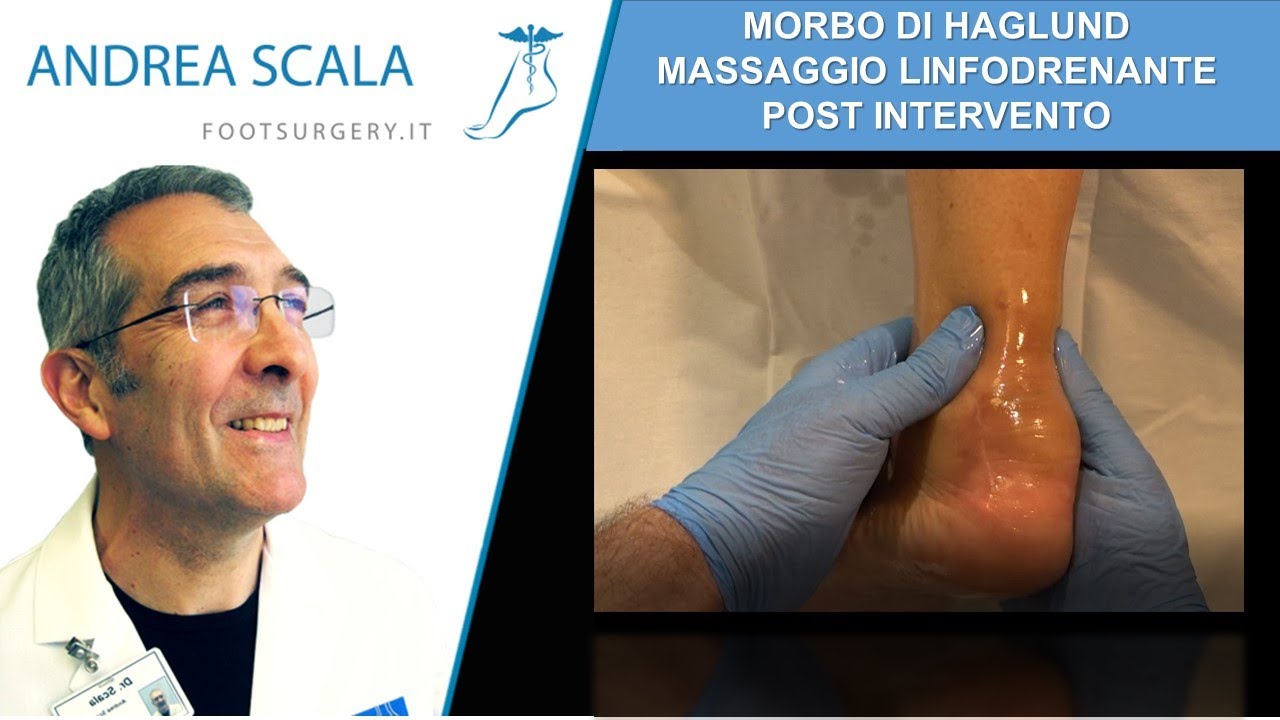 Morbo di Haglund riabilitazione post intervento | Haglund massaggio | Dott. Andrea Scala