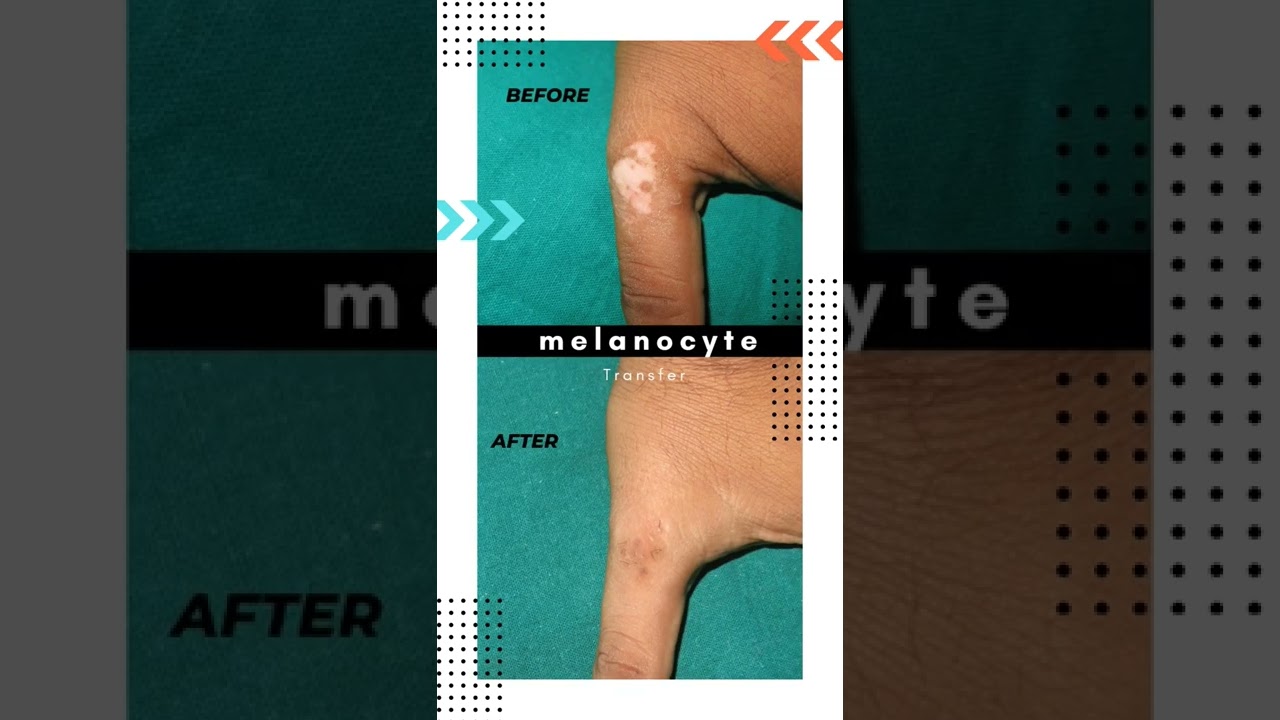 Vitiligo treatment results●Dr Manoj Bachhav