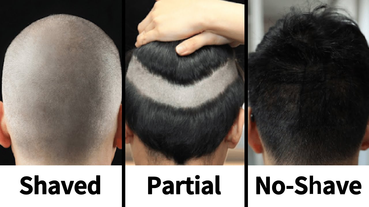 Three Haircut Options for FUE Hair Transplant