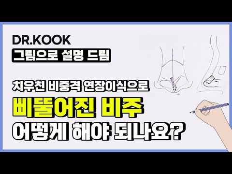코 성형 후 비주가 삐뚤어졌다?! #코끝휨 어떻게 교정해야 되나요?