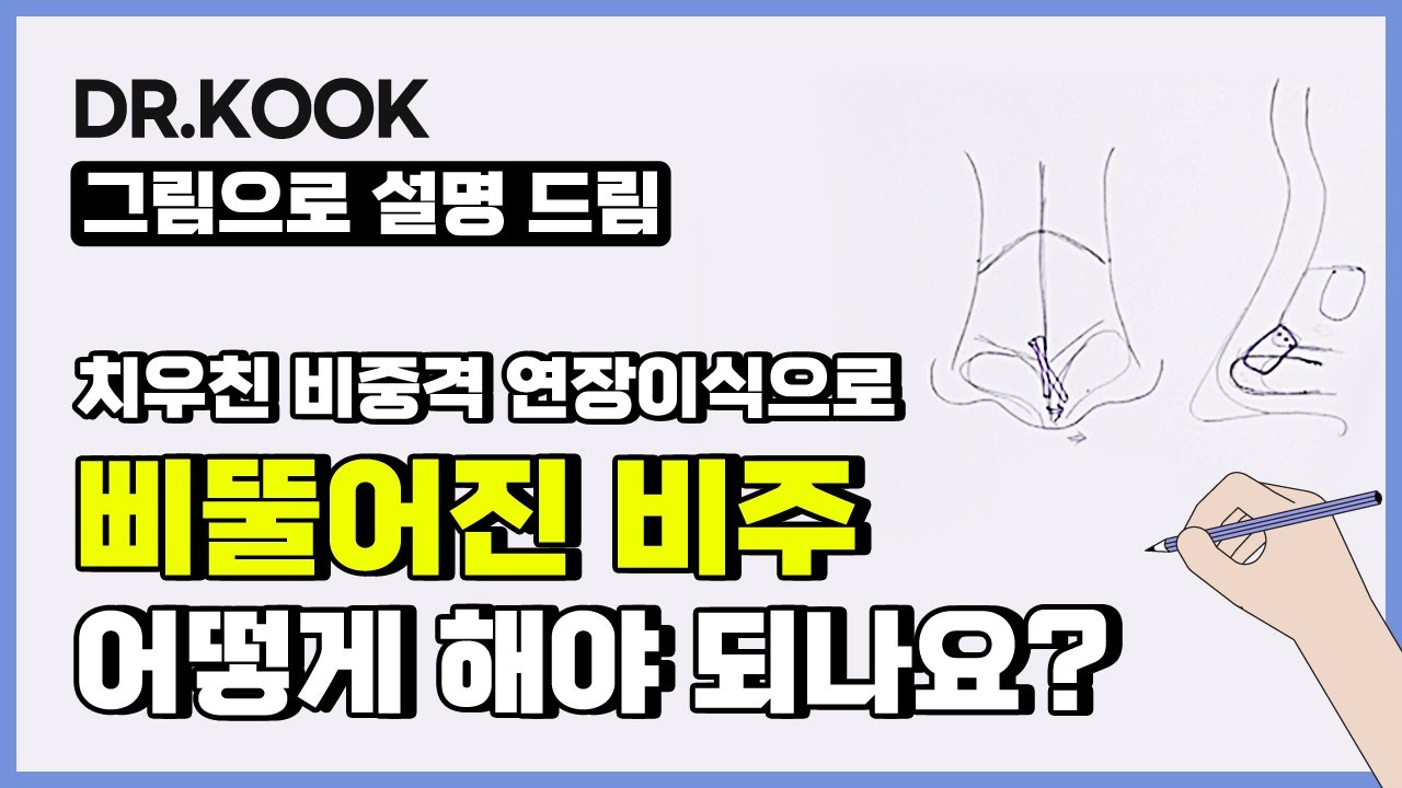 코 성형 후 비주가 삐뚤어졌다?! #코끝휨 어떻게 교정해야 되나요? 썸네일