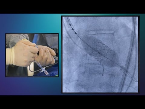 Transcatheter Aortic Valve Replacement (TAVR) – Essentia Health
