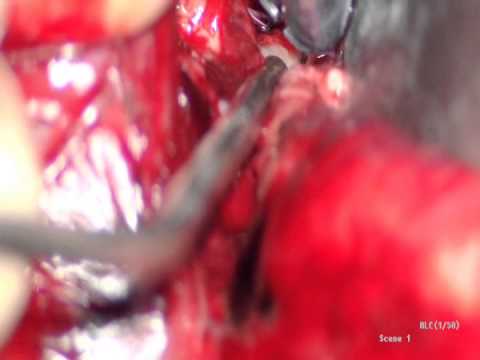 Acute SAH with Left Side MCA Aneurysm