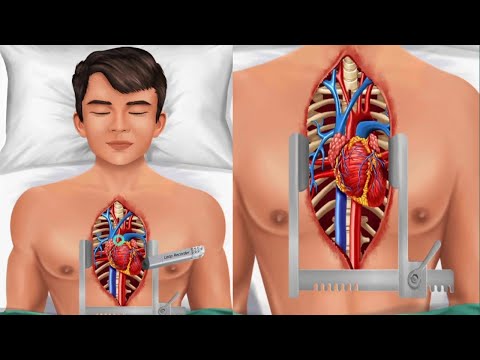 How Does Heart Bypass Surgery work? Coronary Artery Bypass Graft Procedure Animation