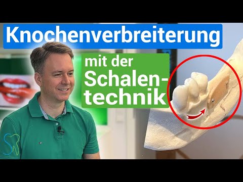 Knochenverbreiterung für Zahnimplantate – die Schalentechnik einfach erklärt