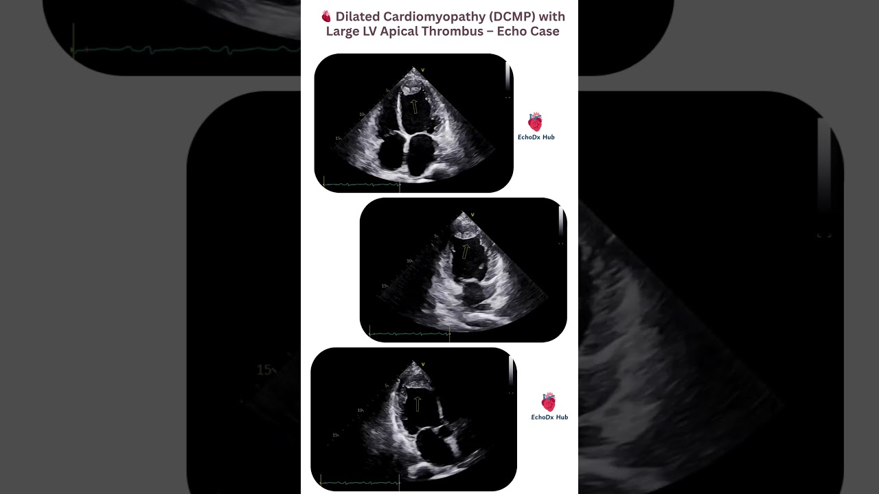 Dilated Cardiomyopathy (DCMP) with Large LV Apical Thrombus – Echo Case