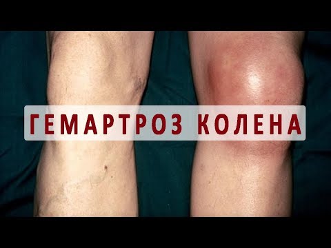 Что нужно знать о гемартрозе коленного сустава