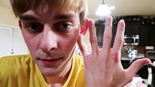 WHAT HAPPENED TO HIS HAND!!