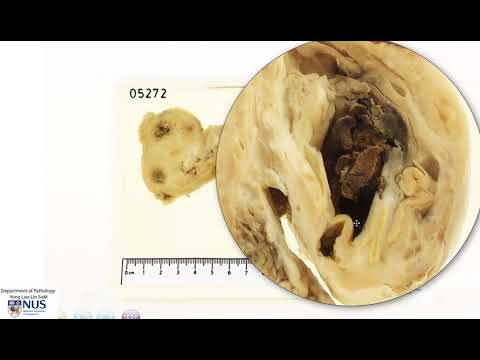 Uterus with adnexae   Endometriotic cyst ("Chocolate cyst")