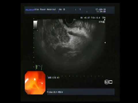 EUS FNA pancreatic mass