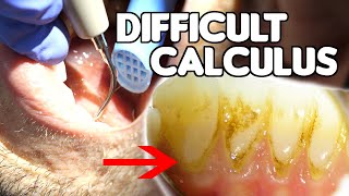 How To Remove Difficult & Tenacious Calculus (Tartar)