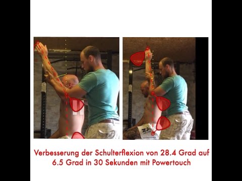 Behandlung von poplitea Gelenke Menschliches Skelett mit Osteochondrose