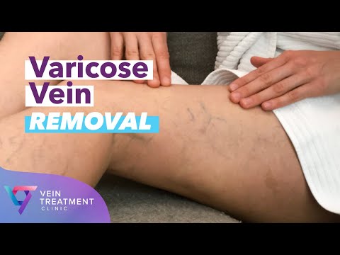 Vein Care Is Self Care | Spider and Varicose Vein Treatment Clinic