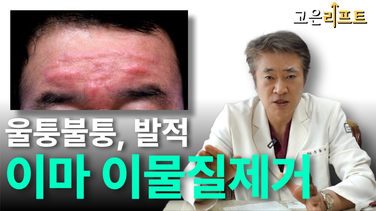 고은리프트 이마 필러 부작용 이물질 제거 유튜브 영상
