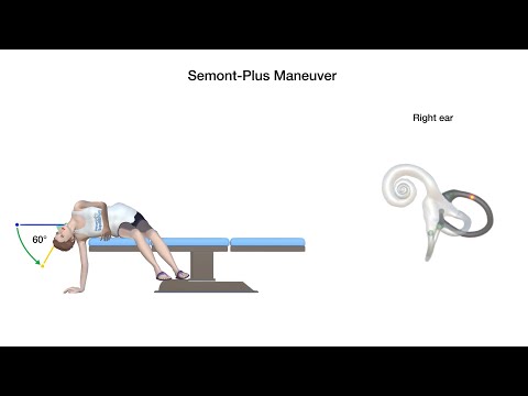 Semont-Plus Maneuver for Right Posterior Canal Benign Paroxysmal Positional Vertigo