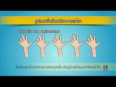 ยาสำหรับโรคสะเก็ดเงิน Vetom และโรคสะเก็ดเงิน